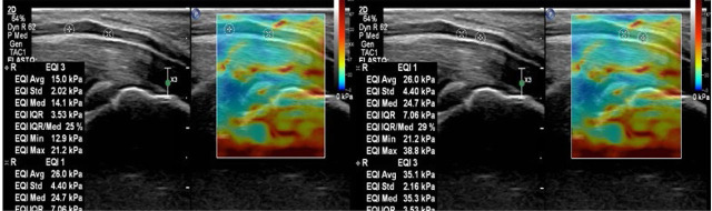 Elastografia tempo formacion 2.jpg